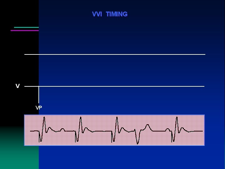 VVI TIMING V VP VP VP VS VP VVI TIMING V VP VP VP VS VP