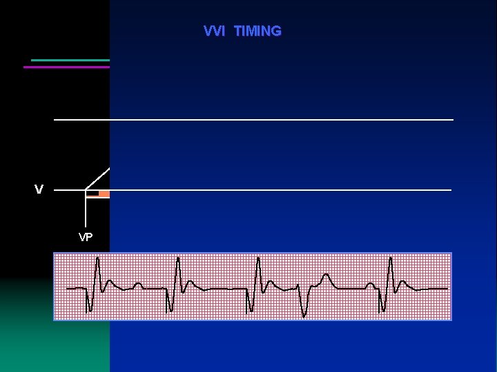 VVI TIMING V VP VP VP VS VP 