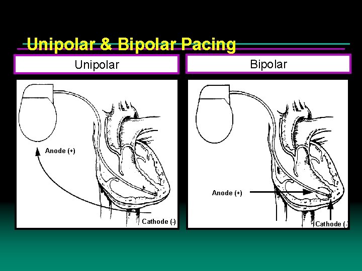 Unipolar & Bipolar Pacing Bipolar Unipolar Anode (+) Cathode (-) Unipolar & Bipolar Pacing Bipolar Unipolar Anode (+) Cathode (-)