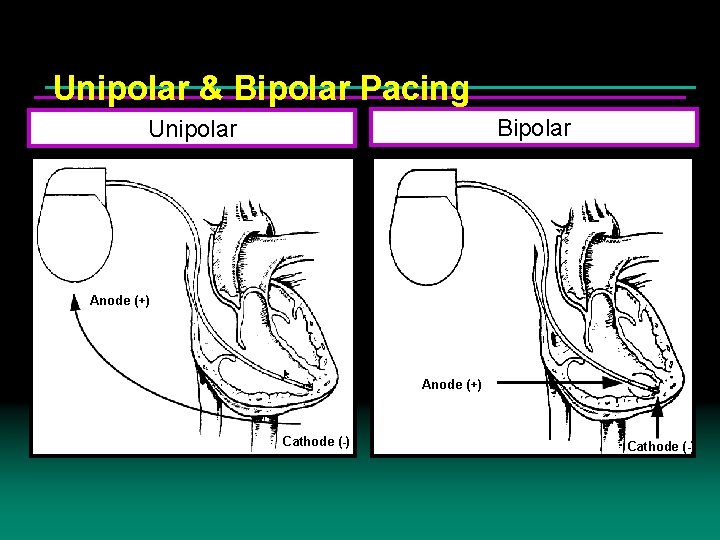 Unipolar & Bipolar Pacing Bipolar Unipolar Anode (+) Cathode (-) 