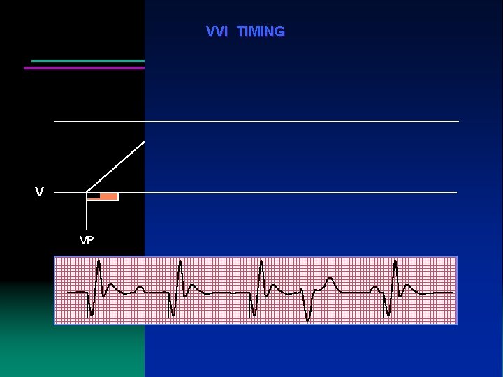 VVI TIMING V VP VP VP VS VP VVI TIMING V VP VP VP VS VP