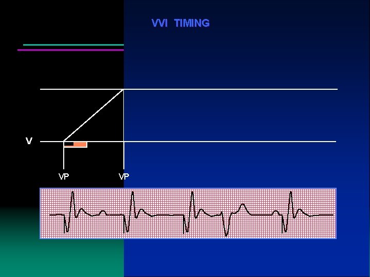 VVI TIMING V VP VP VP VS VP 