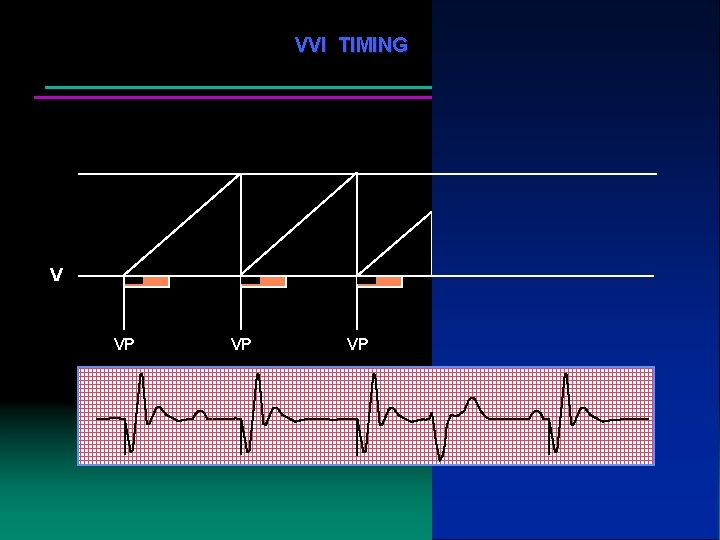 VVI TIMING V VP VP 