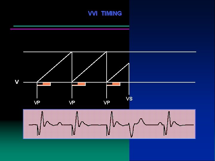 VVI TIMING V VP VP VP VS VP 