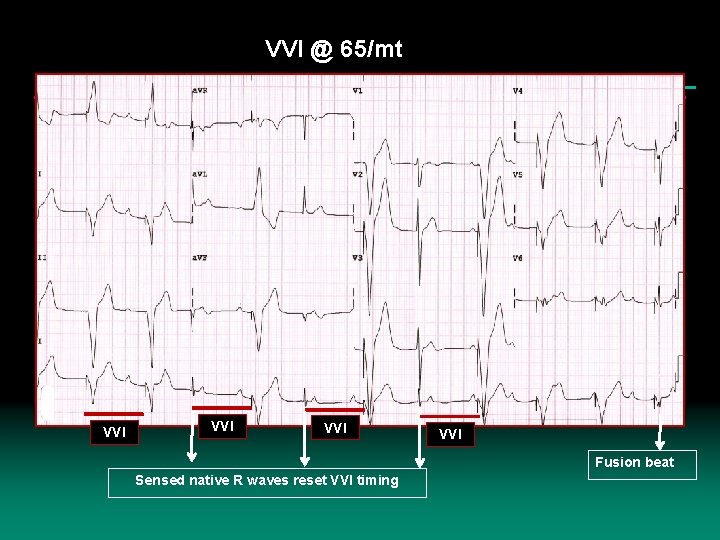 VVI @ 65/mt VVI VVI Fusion beat Sensed native R waves reset VVI timing VVI @ 65/mt VVI VVI Fusion beat Sensed native R waves reset VVI timing