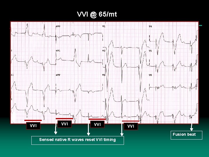 VVI @ 65/mt VVI VVI Fusion beat Sensed native R waves reset VVI timing