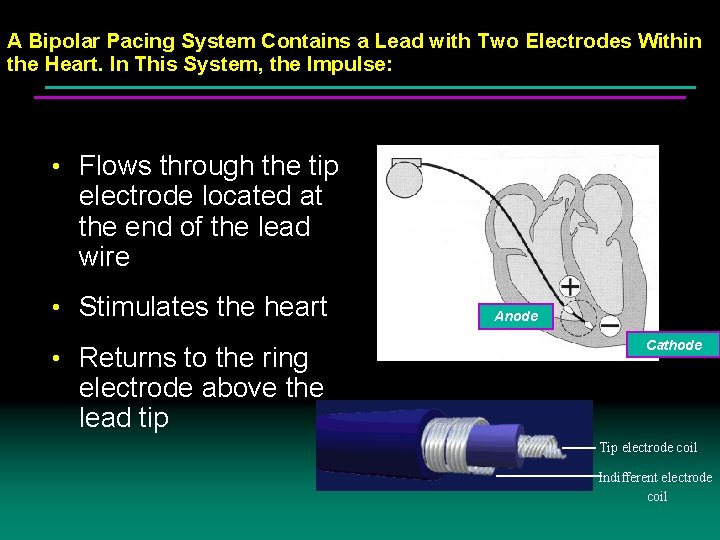 A Bipolar Pacing System Contains a Lead with Two Electrodes Within the Heart. In A Bipolar Pacing System Contains a Lead with Two Electrodes Within the Heart. In