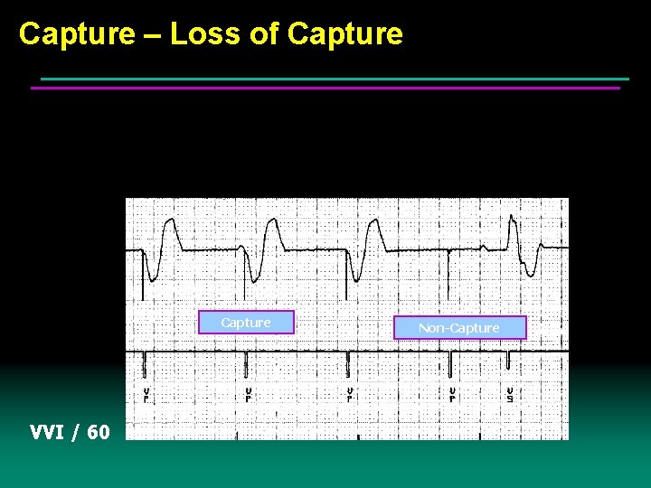 Capture – Loss of Capture VVI / 60 Non-Capture 