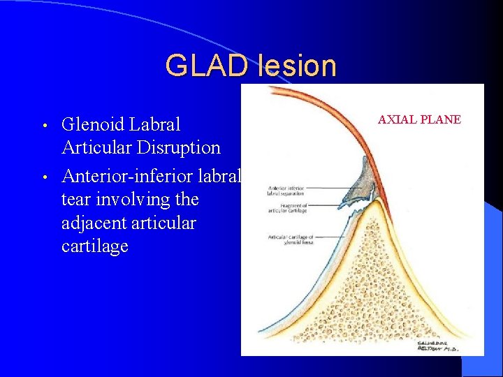 GLAD lesion • • Glenoid Labral Articular Disruption Anterior-inferior labral tear involving the adjacent