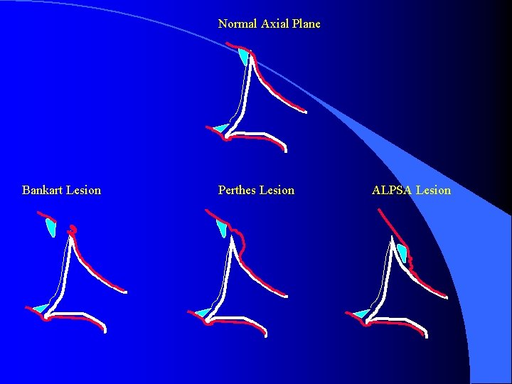 Normal Axial Plane Bankart Lesion Perthes Lesion ALPSA Lesion 
