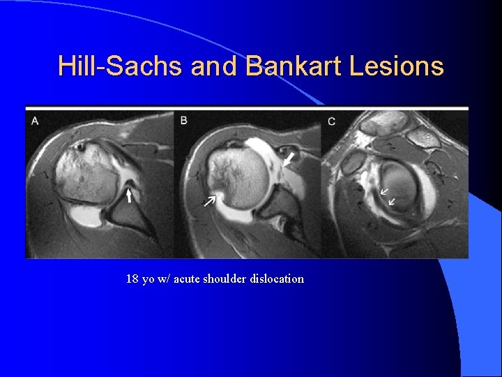 Hill-Sachs and Bankart Lesions 18 yo w/ acute shoulder dislocation 