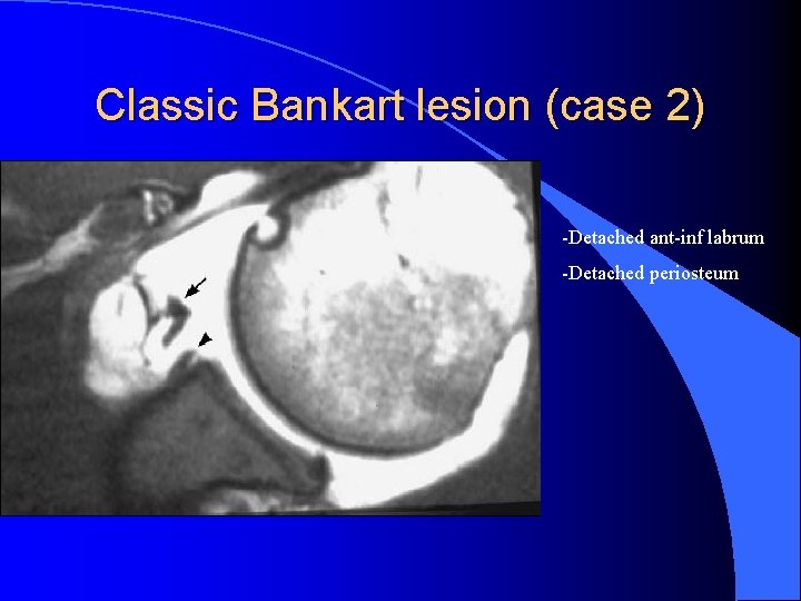 Classic Bankart lesion (case 2) -Detached ant-inf labrum -Detached periosteum 