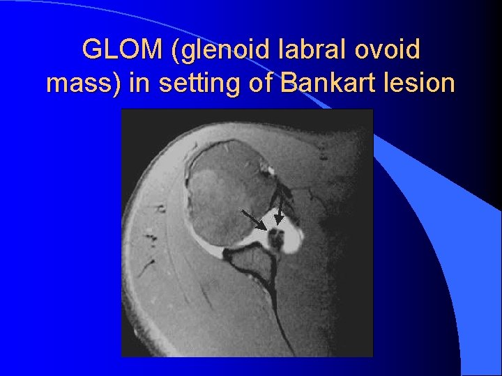 GLOM (glenoid labral ovoid mass) in setting of Bankart lesion 