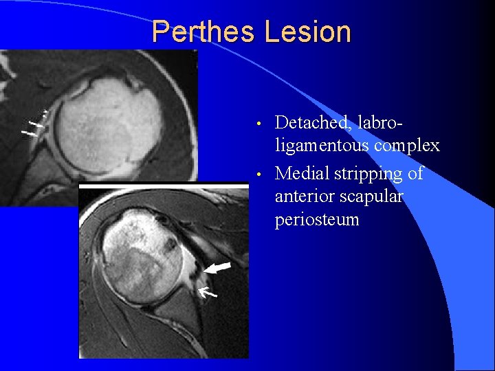 Perthes Lesion • • Detached, labroligamentous complex Medial stripping of anterior scapular periosteum 