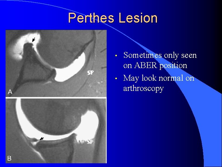 Perthes Lesion • • Sometimes only seen on ABER position May look normal on