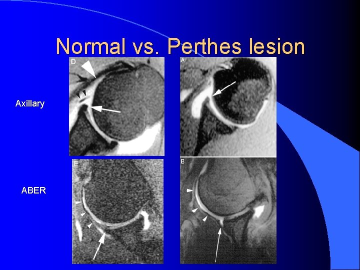 Normal vs. Perthes lesion Axillary ABER 
