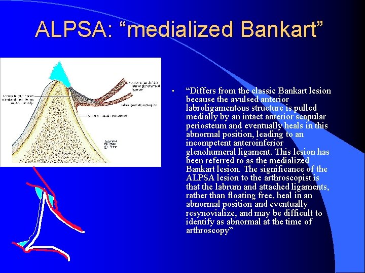 ALPSA: “medialized Bankart” • “Differs from the classic Bankart lesion because the avulsed anterior