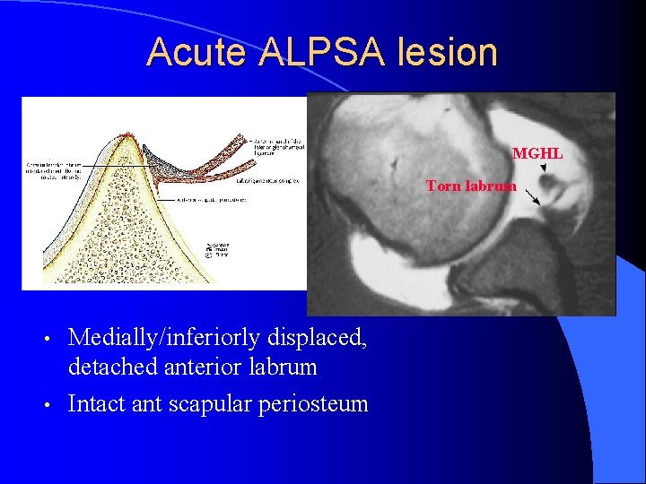 Acute ALPSA lesion MGHL Torn labrum • • Medially/inferiorly displaced, detached anterior labrum Intact