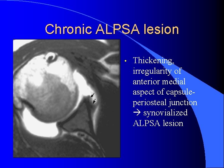 Chronic ALPSA lesion • Thickening, irregularity of anterior medial aspect of capsuleperiosteal junction synovialized