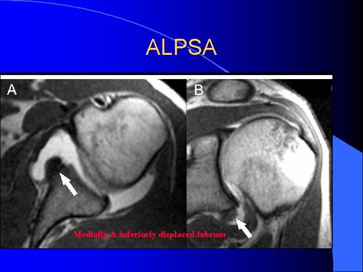 ALPSA Medially & inferiorly displaced labrum 