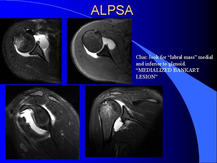 ALPSA Clue: look for “labral mass” medial and inferior to glenoid. “MEDIALIZED BANKART LESION”