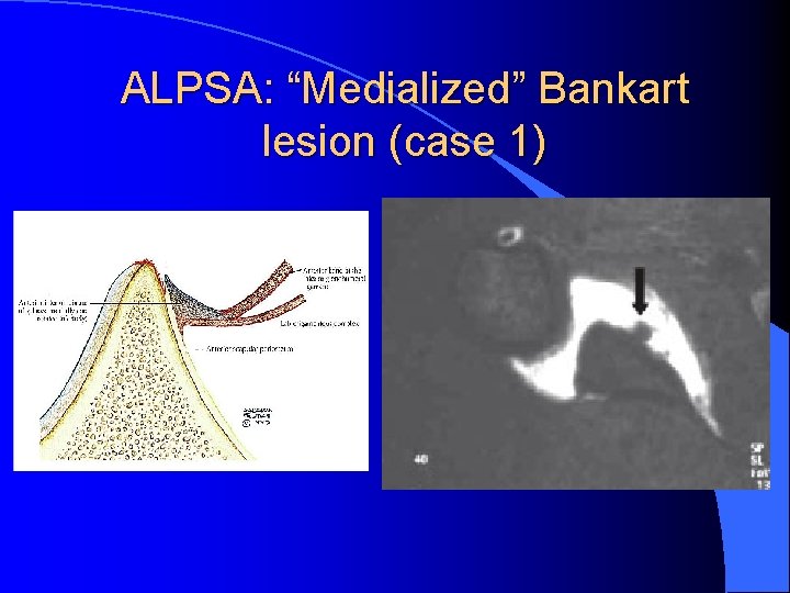 ALPSA: “Medialized” Bankart lesion (case 1) 