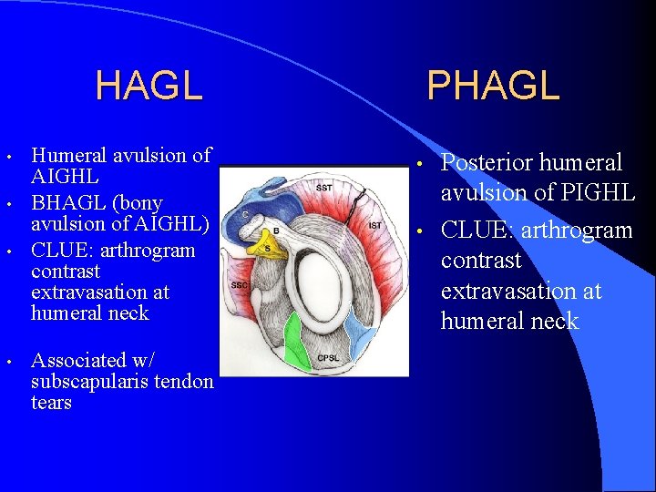 HAGL • • Humeral avulsion of AIGHL BHAGL (bony avulsion of AIGHL) CLUE: arthrogram