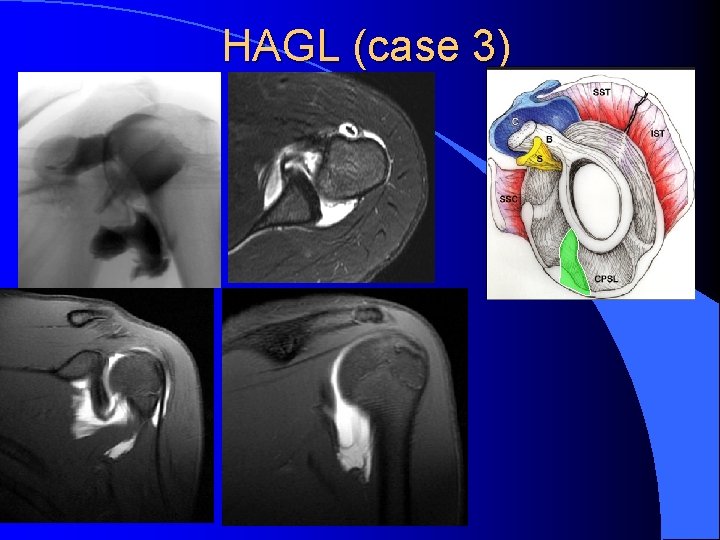 HAGL (case 3) 