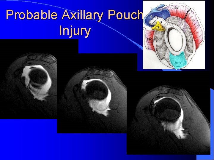 Probable Axillary Pouch Injury 