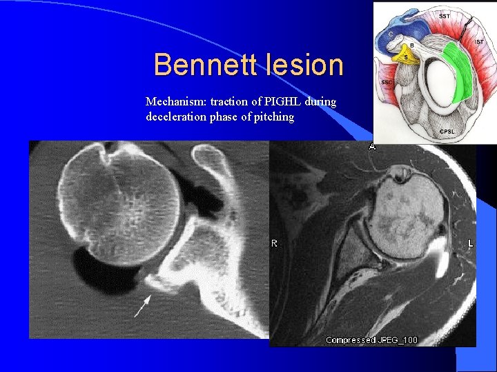 Bennett lesion Mechanism: traction of PIGHL during deceleration phase of pitching 