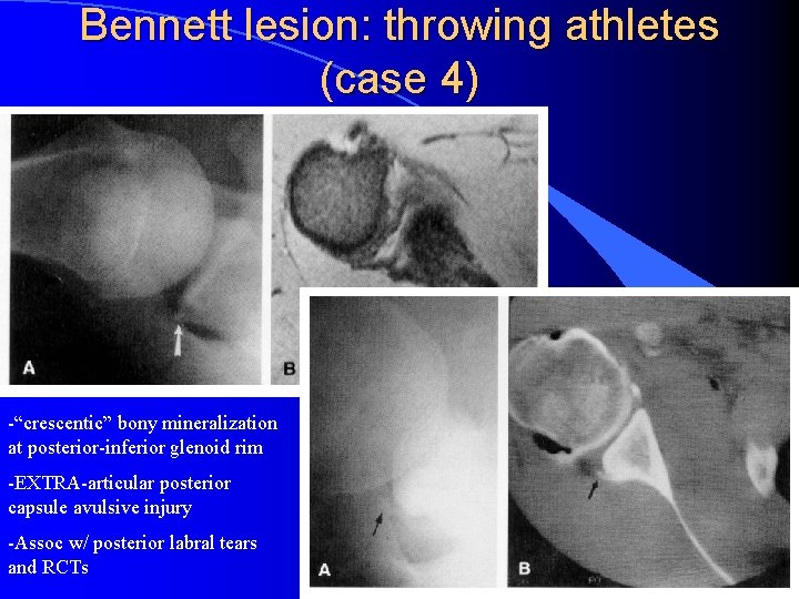 Bennett lesion: throwing athletes (case 4) -“crescentic” bony mineralization at posterior-inferior glenoid rim -EXTRA-articular