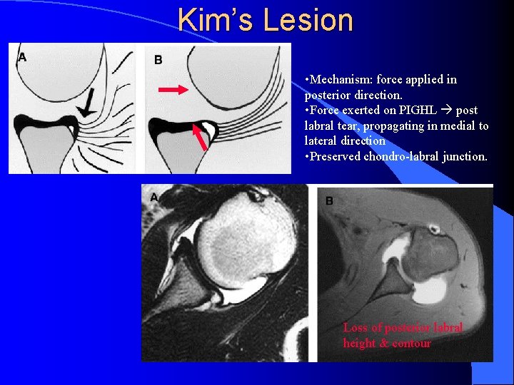 Kim’s Lesion • Mechanism: force applied in posterior direction. • Force exerted on PIGHL