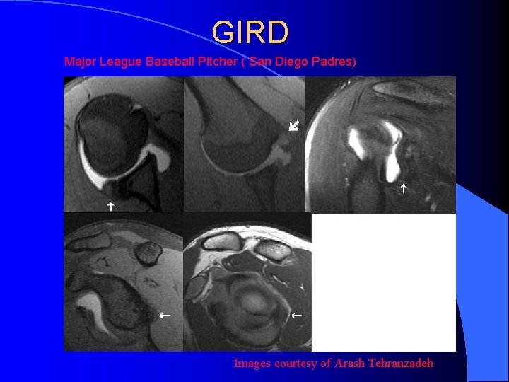 GIRD Major League Baseball Pitcher ( San Diego Padres) Images courtesy of Arash Tehranzadeh