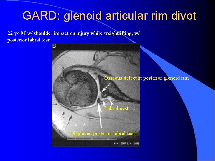 GARD: glenoid articular rim divot 22 yo M w/ shoulder impaction injury while weightlifting,