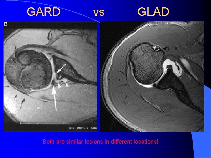 GARD vs GLAD Both are similar lesions in different locations! 