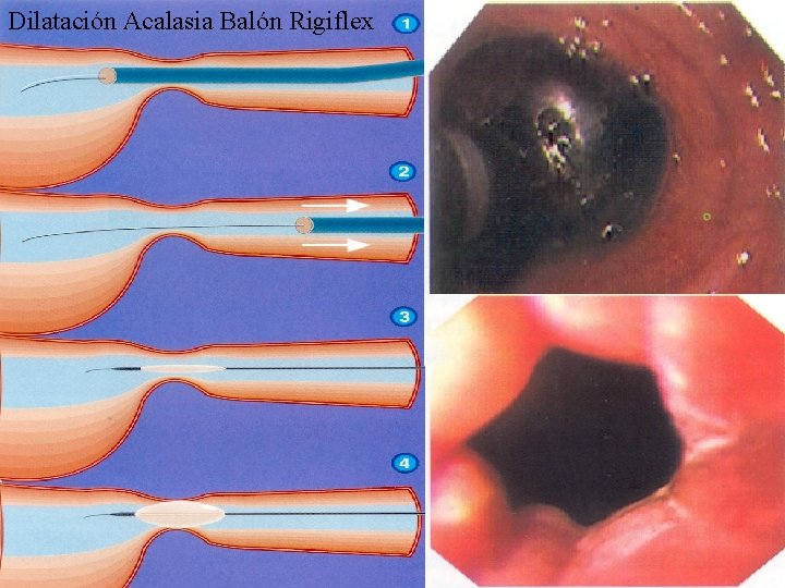 Dilatación Acalasia Balón Rigiflex 
