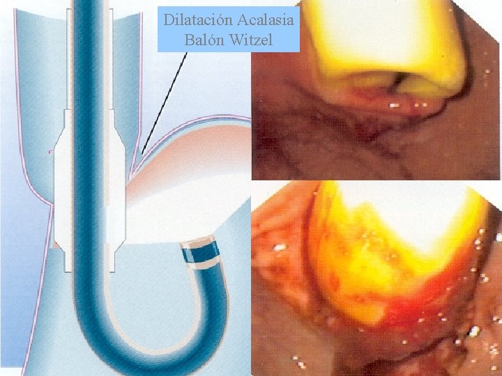 Dilatación Acalasia Balón Witzel 