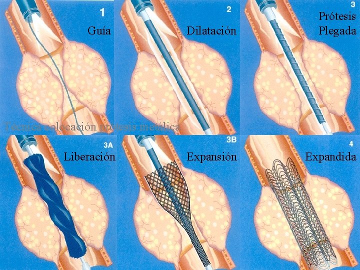 Guía Dilatación Prótesis Plegada Expansión Expandida Técnica colocación prótesis metálica Liberación 