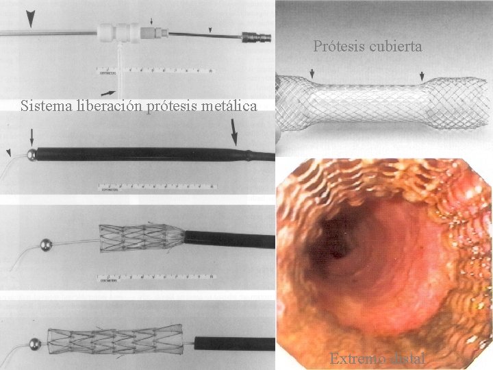 Prótesis cubierta Sistema liberación prótesis metálica Extremo distal 