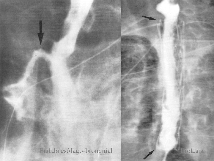 Fístula esófago-bronquial Prótesis 