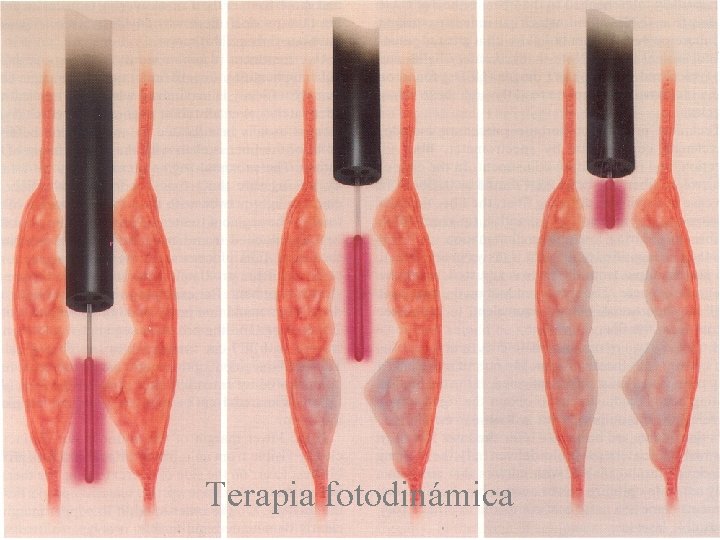 Terapia fotodinámica 