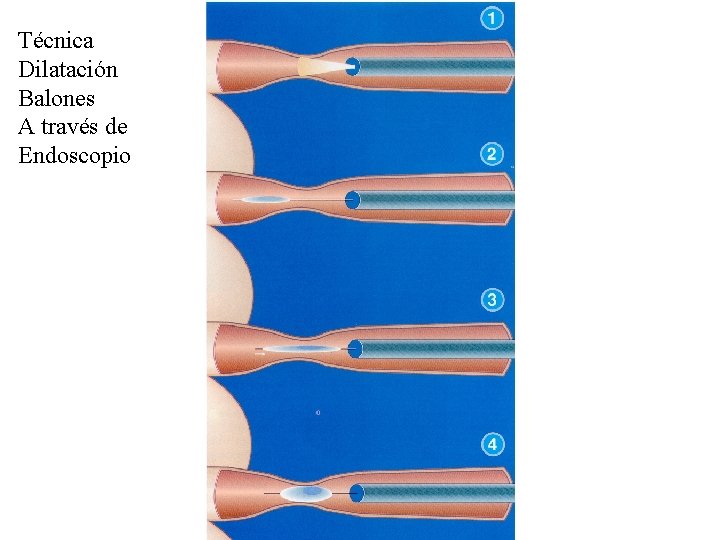 Técnica Dilatación Balones A través de Endoscopio 