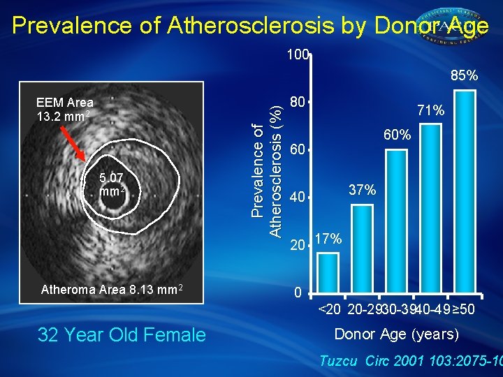 Prevalence of Atherosclerosis by Donor Age 100 EEM Area 13. 2 mm 2 5.