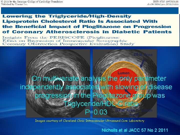 Intravascular Ultrasound of Coronary Arteries Determining the Atheroma Area Precise planimetry of EEM and