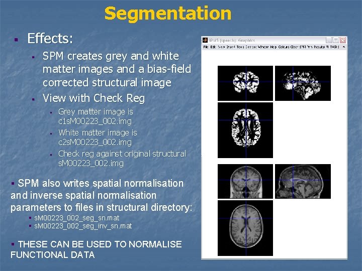 Segmentation § Effects: § § SPM creates grey and white matter images and a