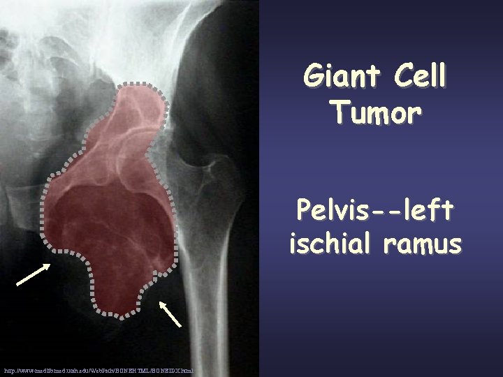 Giant Cell Tumor Pelvis--left ischial ramus http: //www-medlib. med. utah. edu/Web. Path/BONEHTML/BONEIDX. html 