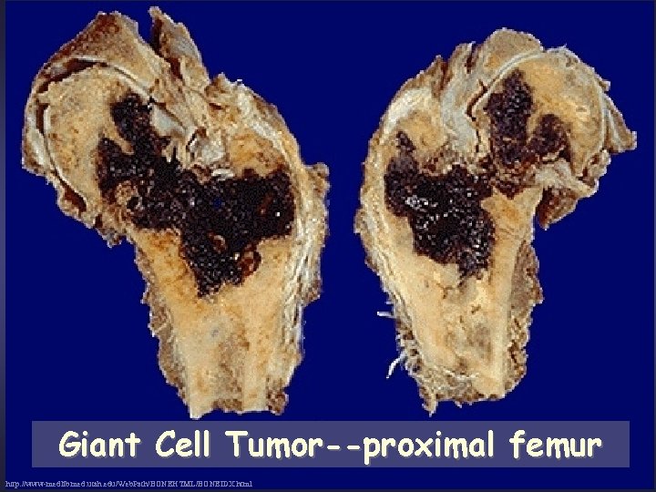 Giant Cell Tumor--proximal femur http: //www-medlib. med. utah. edu/Web. Path/BONEHTML/BONEIDX. html 