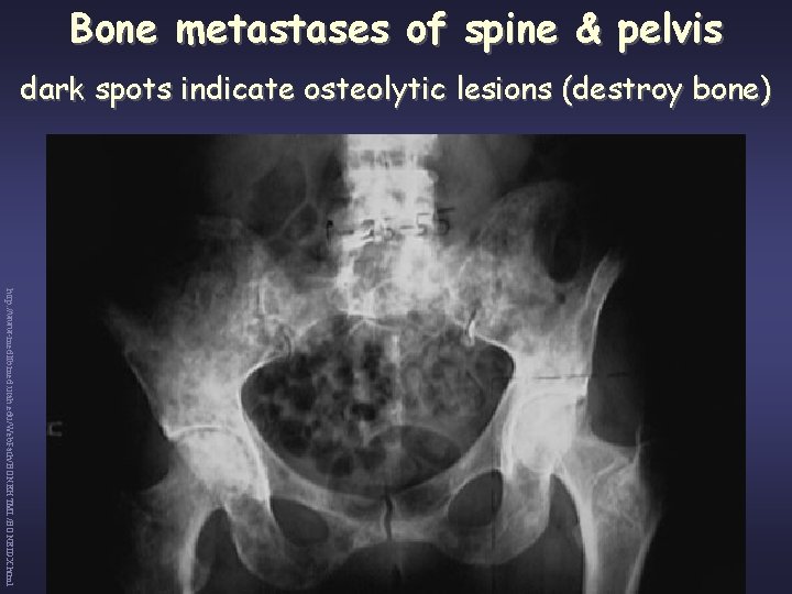 Bone metastases of spine & pelvis dark spots indicate osteolytic lesions (destroy bone) http: