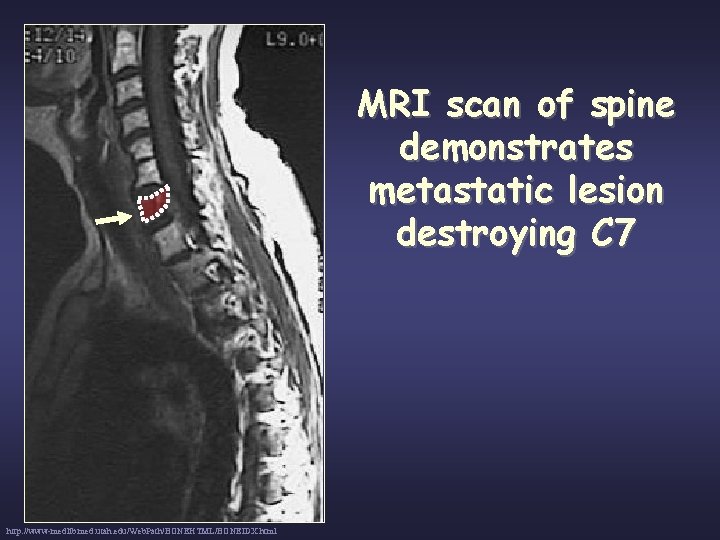 MRI scan of spine demonstrates metastatic lesion destroying C 7 http: //www-medlib. med. utah.