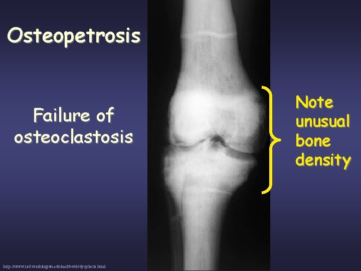 Osteopetrosis Failure of osteoclastosis http: //www. rad. washington. edu/mskbook/dysplasia. html Note unusual bone density